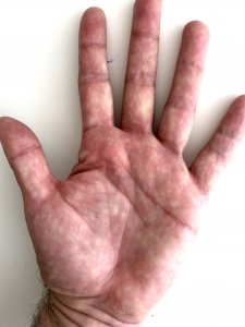 hand-palmtherapy